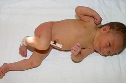 孩子得了隱睪癥怎么辦 孩子隱睪是什么原因 孩子得了隱睪癥怎么辦 孩子隱睪是什么原因