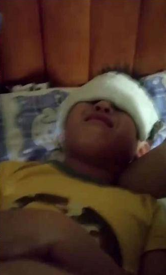 紫外線燈多名小學生灼傷是怎么回事 紫外線燈灼傷嚴重嗎