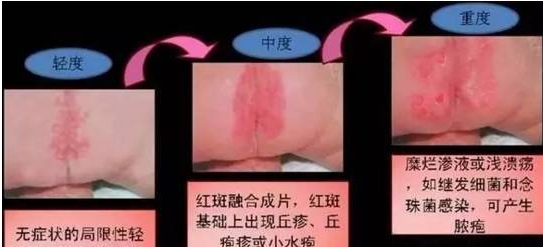 寶寶得尿布疹和尿不濕有關系嗎 寶寶尿布疹嚴重怎么辦 寶寶得尿布疹和尿不濕有關系嗎 寶寶尿布疹嚴重怎么辦