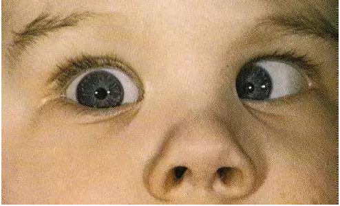 兒童斜視什么時間治療最好 如何判斷兒童斜視