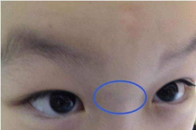 寶寶鼻梁上有青筋是不好帶嗎 寶寶鼻梁上有青筋怎么辦