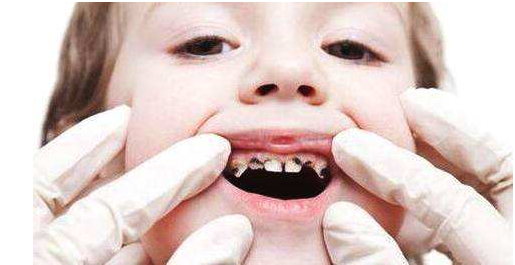 寶寶牙齒黑是怎么回事 寶寶牙齒發(fā)黑怎么辦