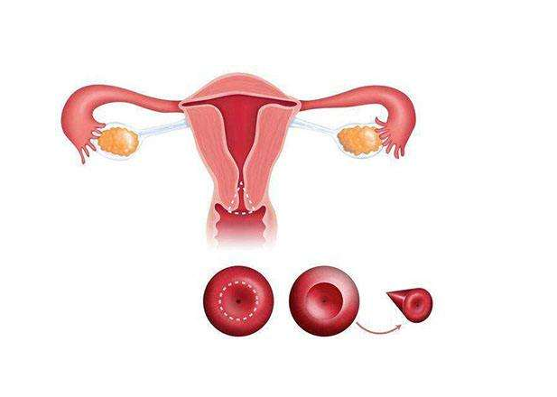 子宮內(nèi)膜異位癥可以自愈嗎 子宮內(nèi)膜異位癥如何治療