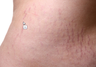 妊娠紋怎么辦 怎么預(yù)防呢