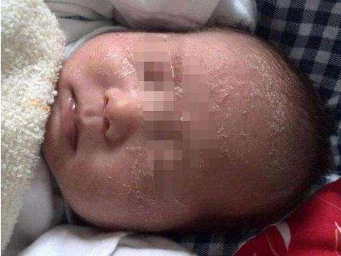 新生兒蛻皮正常嗎 新生兒蛻皮護(hù)理怎么做 新生兒蛻皮正常嗎 新生兒蛻皮護(hù)理怎么做