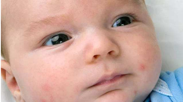 寶寶蛋白質過敏怎么辦 嬰幼兒牛奶蛋白質過敏原因