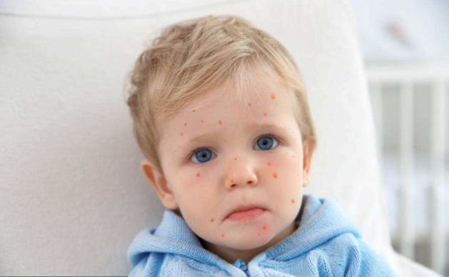 寶寶出了水痘還需要打水痘疫苗嗎 寶寶水痘疫苗什么時候打