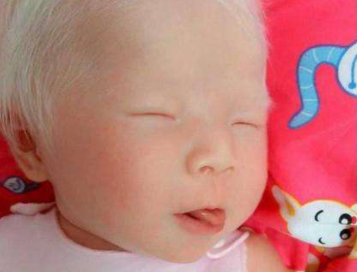 白化病產(chǎn)前檢查能查出來嗎 白化病能活多久 白化病產(chǎn)前檢查能查出來嗎 白化病能活多久