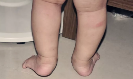 寶寶站立時腳外翻是什么原因 站立時腳外翻正常嗎 寶寶站立時腳外翻是什么原因 站立時腳外翻正常嗎