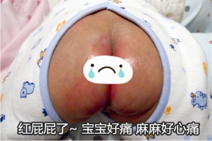 嬰兒紅屁股怎樣好得快 嬰兒紅屁股怎么辦