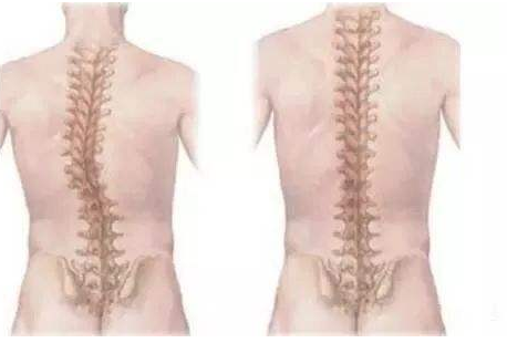 孩子脊柱側彎是怎么引起的 脊柱側彎的治療的黃金時期