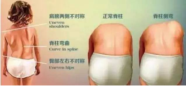 孩子脊柱側彎是怎么引起的 脊柱側彎的治療的黃金時期