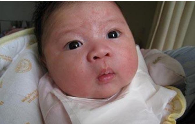 哪些寶寶容易得濕疹 如何預防寶寶長濕疹