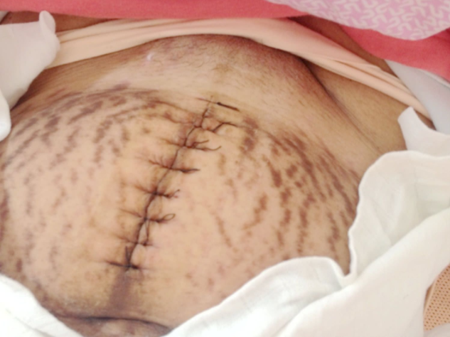 剖腹產橫切還是豎切好 剖腹產橫切豎切優缺點