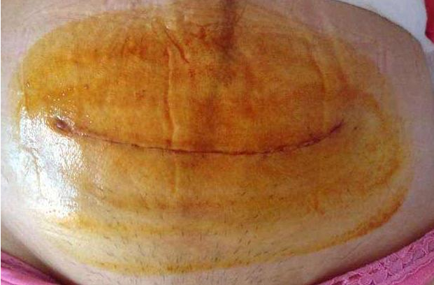 剖腹產橫切還是豎切好 剖腹產橫切豎切優缺點