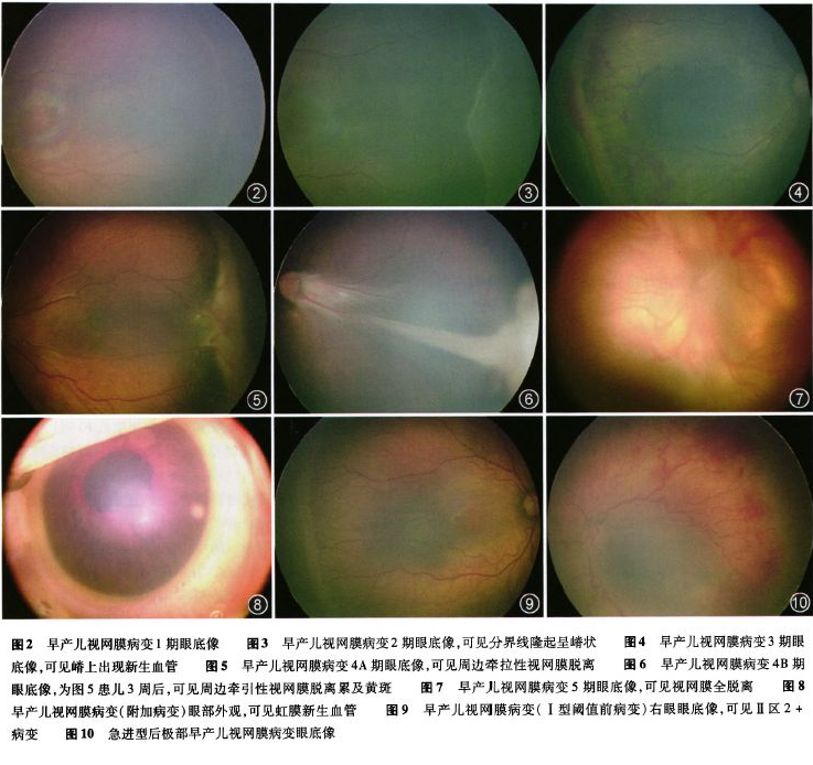 早產(chǎn)兒視網(wǎng)膜病變是什么疾病 早產(chǎn)兒視網(wǎng)膜病變能治好嗎