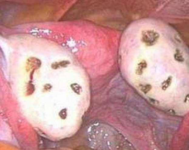 多囊懷孕幾率大嗎 多囊懷孕需要注意什么 多囊懷孕幾率大嗎 多囊懷孕需要注意什么