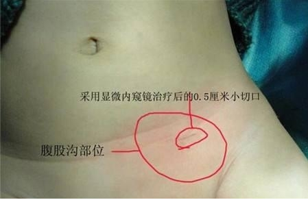 小兒疝氣會自愈嗎 小兒疝氣如何治療 小兒疝氣會自愈嗎 小兒疝氣如何治療