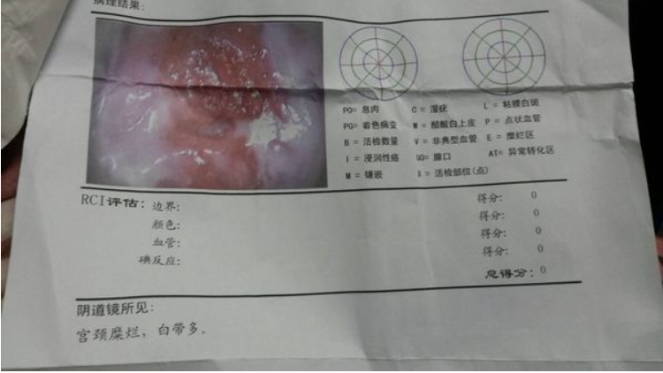 宮頸糜爛會影響懷孕嗎 得了宮頸糜爛怎么辦 宮頸糜爛會影響懷孕嗎 得了宮頸糜爛怎么辦