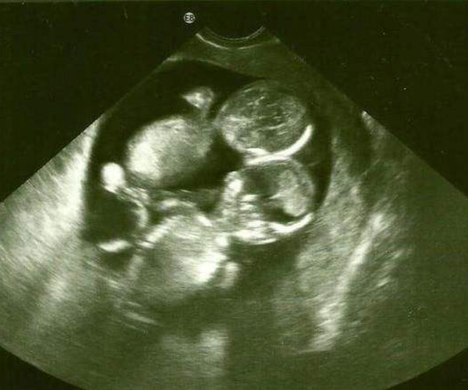 什么情況下容易生雙胞胎 懷雙胞胎有什么癥狀