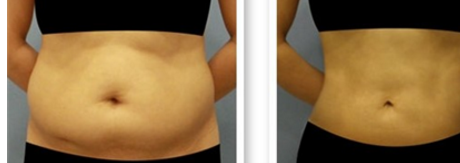 抽脂的危害有哪些 這些要注意了 抽脂的危害有哪些 這些要注意了