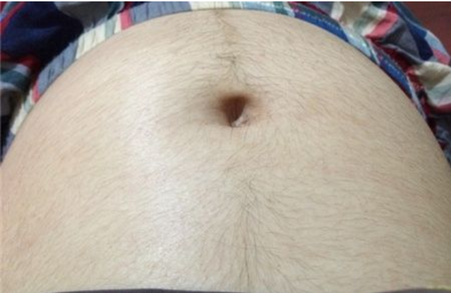 孕婦肚皮長毛是什么情況 孕婦肚皮長毛怎么辦 孕婦肚皮長毛是什么情況 孕婦肚皮長毛怎么辦