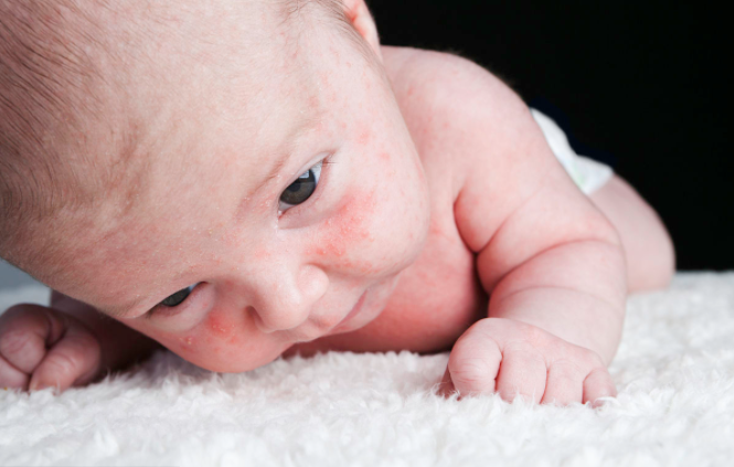 新生兒痤瘡多久能好 新生兒痤瘡怎么護理好 新生兒痤瘡多久能好 新生兒痤瘡怎么護理好