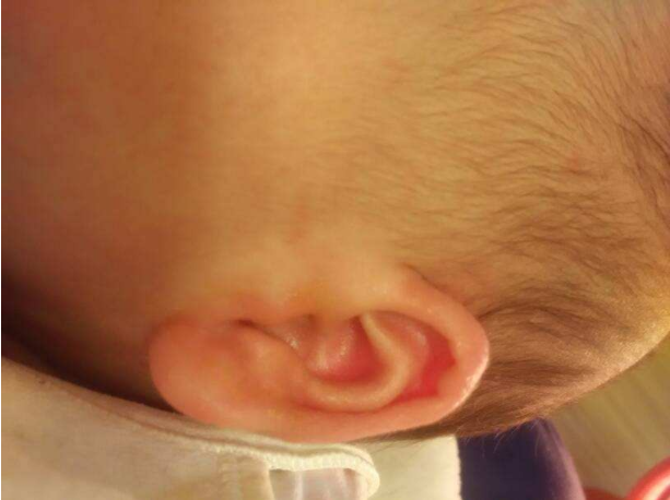 寶寶耳朵流黃水是怎么回事 寶寶耳朵流黃水怎么辦 寶寶耳朵流黃水是怎么回事 寶寶耳朵流黃水怎么辦