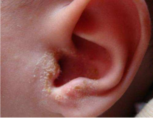 寶寶耳朵流黃水是怎么回事 寶寶耳朵流黃水怎么辦 寶寶耳朵流黃水是怎么回事 寶寶耳朵流黃水怎么辦