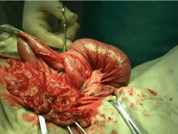 寶寶得了腸套疊怎么辦 小兒腸套疊是什么造成的