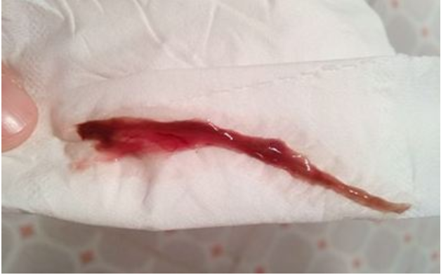 懷孕初期見血是男孩嗎 孕初期出血是怎么回事 懷孕初期見血是男孩嗎 孕初期出血是怎么回事