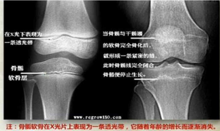 孕期懷孕會長高嗎 怎么判斷骨骺線有沒有閉合