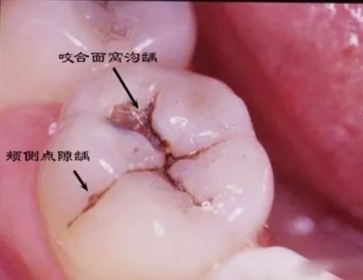 孩子牙齒上的黑線是什么 孩子牙齒上的黑線怎么處理 孩子牙齒上的黑線是什么 孩子牙齒上的黑線怎么處理