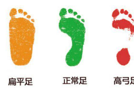 為何新生兒都是扁平足呢 扁平足如何矯正