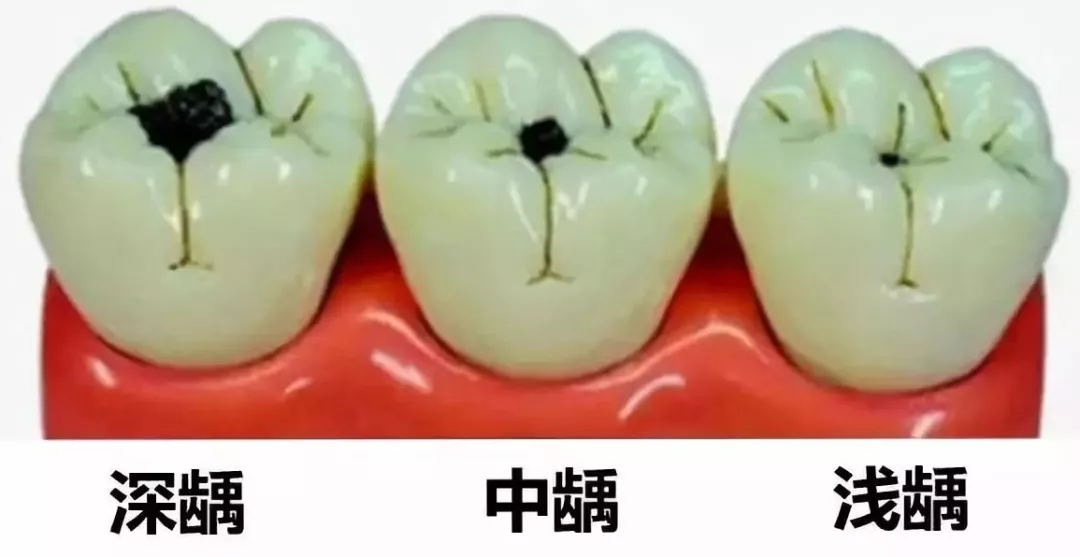 怎么保護乳牙比較好 窩溝封閉如何操作才安全 怎么保護乳牙比較好 窩溝封閉如何操作才安全