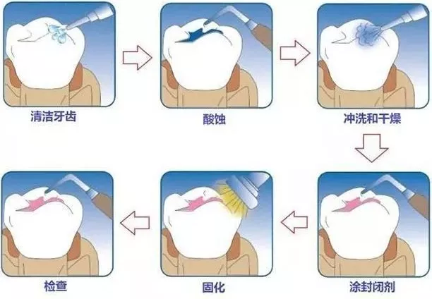 怎么保護乳牙比較好 窩溝封閉如何操作才安全 怎么保護乳牙比較好 窩溝封閉如何操作才安全