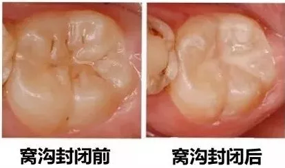 怎么保護乳牙比較好 窩溝封閉如何操作才安全 怎么保護乳牙比較好 窩溝封閉如何操作才安全