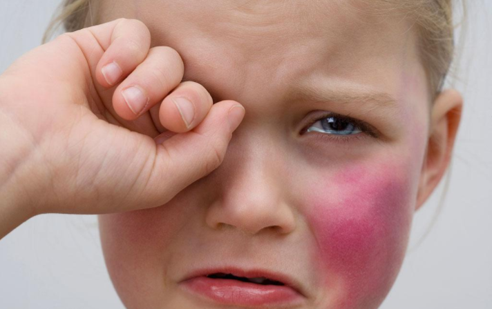 寶寶臉腫脹是得了流行性腮腺炎嗎 寶寶得流行性腮腺炎有什么癥狀 寶寶臉腫脹是得了流行性腮腺炎嗎 寶寶得流行性腮腺炎有什么癥狀