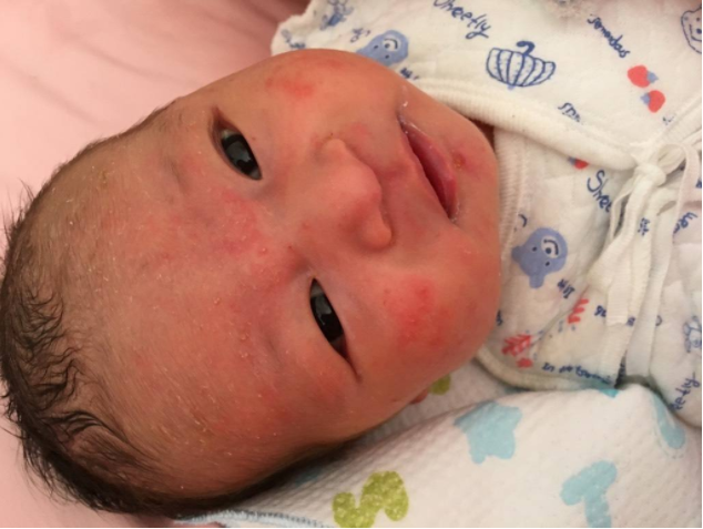 冬季寶寶容易長濕疹怎么辦 冬季寶寶長濕疹常見原因