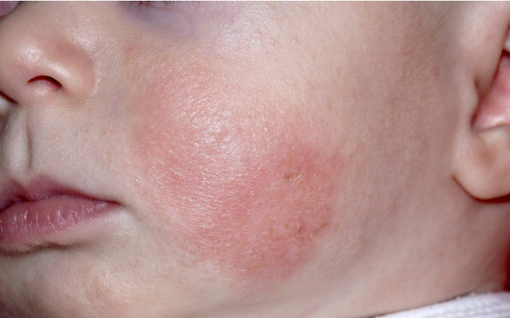 冬季寶寶容易長濕疹怎么辦 冬季寶寶長濕疹常見原因