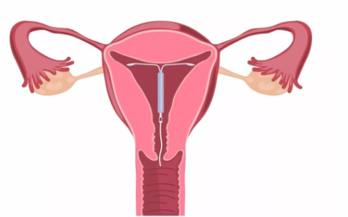 節(jié)育環(huán)有哪些類(lèi)型 國(guó)內(nèi)外節(jié)育環(huán)種類(lèi)介紹 節(jié)育環(huán)有哪些類(lèi)型 國(guó)內(nèi)外節(jié)育環(huán)種類(lèi)介紹