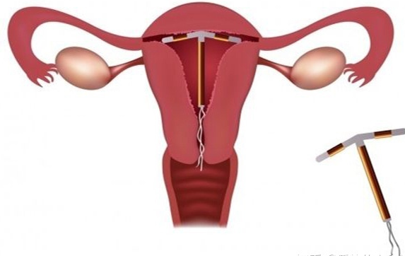 節育環有副作用嗎 節育環副作用介紹 節育環有副作用嗎 節育環副作用介紹