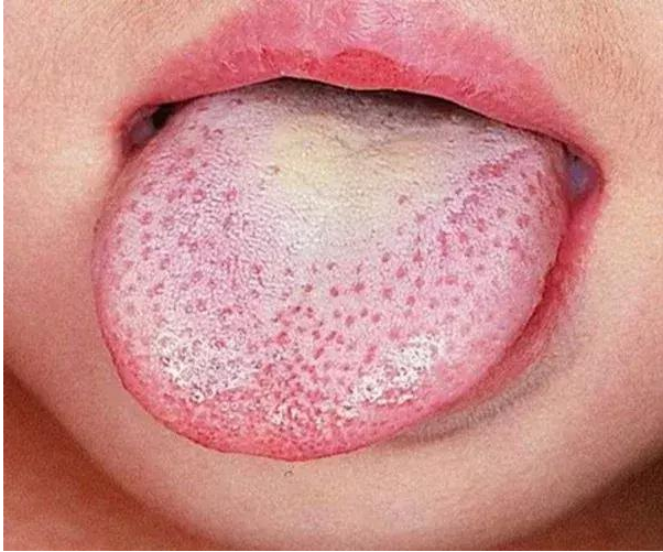 猩紅熱有哪些臨床癥狀 小孩得了猩紅熱怎么辦