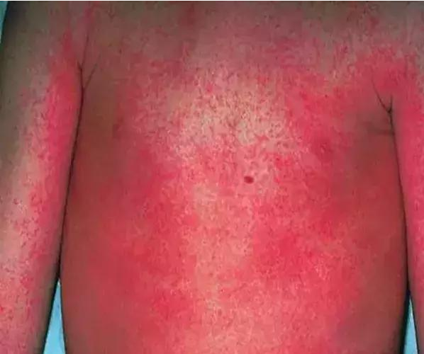 猩紅熱有哪些臨床癥狀 小孩得了猩紅熱怎么辦