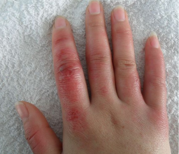 冬季寶寶容易長凍瘡怎么辦 冬季寶寶怎么預防長凍瘡 冬季寶寶容易長凍瘡怎么辦 冬季寶寶怎么預防長凍瘡