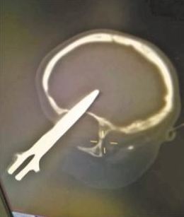 剪刀插入2歲男孩左眼是怎么回事 男孩左眼失明了嗎 剪刀插入2歲男孩左眼是怎么回事 男孩左眼失明了嗎