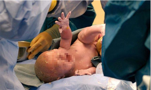  產婦咳嗽是羊水栓塞嗎 羊水栓塞為什么咳嗽