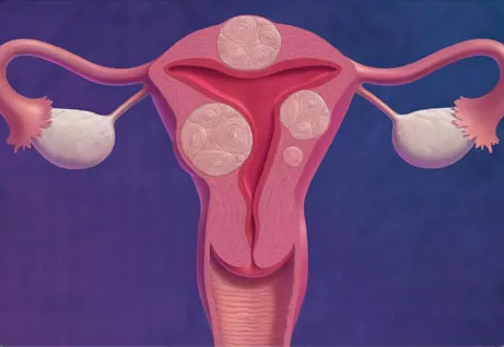 宮腔粘連有什么癥狀 宮腔粘連可以治愈嗎