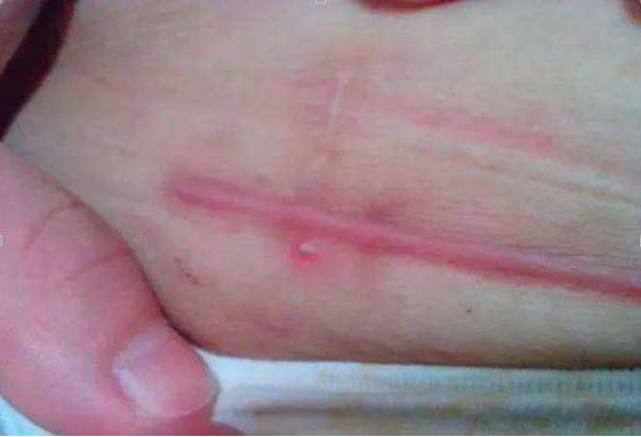 剖腹產疤痕對女性有什么影響 剖腹產女性疤痕不明顯是什么原因