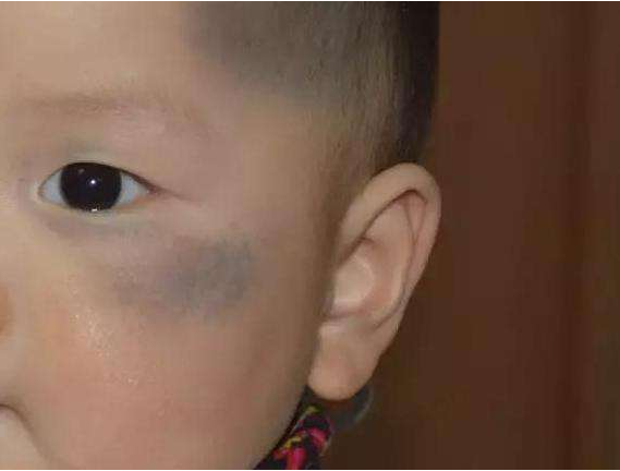 寶寶胎記會自己消失嗎 影響胎記形成的因素